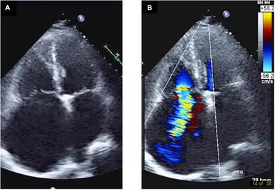 Case report: SGLT2i, transcutaneous vagus nerve stimulation, and their effects on intrarenal venous flow pattern in HFpEF